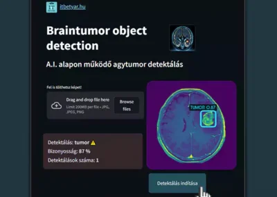 Brain tumor – Object recognition